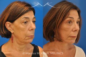 Photo of a patient before and after a procedure. Revision Facelift with Brow Lift and Eyelid Surgery - This 65 year old lady had previously undergone a facelift operation at age 48. She was unhappy with the aged appearance of her brow, eyes, mouth, and neck which made her look tired and sad. She underwent Revision SMAS facelift, endoscopic brow lift, upper and lower blepharoplasty.