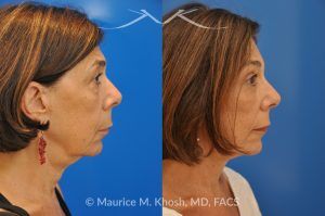 Photo of a patient before and after a procedure. Revision Facelift with Brow Lift and Eyelid Surgery - This 65 year old lady had previously undergone a facelift operation at age 48. She was unhappy with the aged appearance of her brow, eyes, mouth, and neck which made her look tired and sad. She underwent Revision SMAS facelift, endoscopic brow lift, upper and lower blepharoplasty.