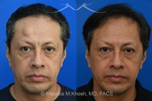 Photo of a patient before and after a procedure. Endoscopic Forehead Lipoma Removal with Hidden Hairline Incision - The lipoma in this picture had been enlarging over a number of years. The patient wished to avoid a visible scar in the forehead. We utilized an endoscopic approach within the hairline to remove this large lipoma. The forehead is now perfectly smooth and there is NO visible scar from the endoscopic approach. 