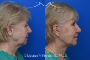 Photo of a patient before and after a procedure. Deep Plane Facelift with Brow and Eyelid Rejuvenation - Our delightful patient was interested in overall facial rejuvenation. She underwent lower blepharoplasty with orbital fat repositioning, temporal brow lift, and a deep plane facelift. She is ecstatic with her surgical results.