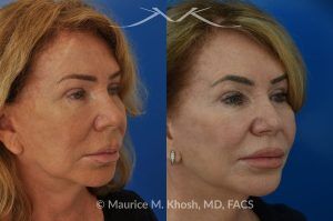 Photo of a patient before and after a procedure. Upper Lip Rejuvenation Surgery - This 65 year old desired a rejuvenated upper lip. She noted the upper lip to be excessively long, covering her upper teeth and giving her a tired and aged appearance. Lip fillers only exacerbated the problem. The post op photos on the right side show her results at 6 months after surgery.