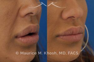 Photo of a patient before and after a procedure. Lip Reduction - Lip reduction to improve the swollen appearing upper lip, which was caused by Silocone injection of the lips