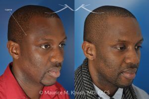 Photo of a patient before and after a procedure. Right Temple Lipoma Removal - Before and after photo showing the removal of a lipoma (benign fatty growth) from the right temple.