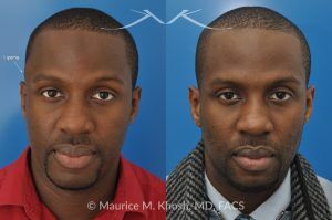 Photo of a patient before and after a procedure. Right Temple Lipoma Removal - Before and after photo showing the removal of a lipoma (benign fatty growth) from the right temple.