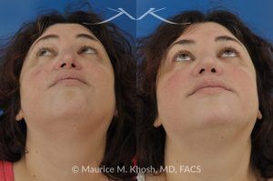 Photo of a patient before and after a procedure. Nasal Valve Repair with Rib Cartilage Graft - Nasal valve repair (repair of nasal vestibular stenosis) with rib cartilage graft.