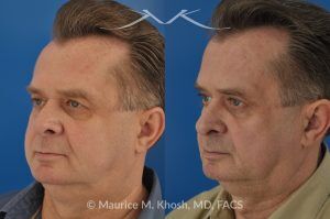 Photo of a patient before and after a procedure. Upper Eyelid Lift - Upper eyelid lift (upper blepharoplasty) to remove excess skin weighing on the eyelashes.