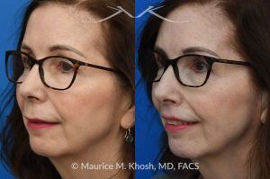 Photo of a patient before and after a procedure. Lip Lift - before and after lip lift procedure showing natural enhancement and improved shape of the lips.