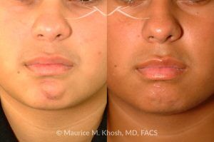 Photo of a patient before and after a procedure. Scar Revision of the Neck Due to Surgical Tracheostomy - pre- and post-operative.