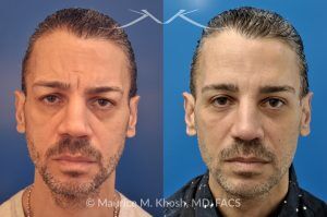 Photo of a patient before and after a procedure. Botox, Cheek Filler, and Upper Blepharoplasty - 55-year-old gentleman treated with Botox Cosmetic to smooth forehead wrinkles and smile lines, and Voluma cheek filler to restore mid-face volume. Upper blepharoplasty was also performed to remove sagging upper eyelids, enhancing overall facial rejuvenation.