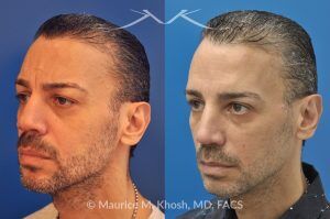 Photo of a patient before and after a procedure. Botox, Cheek Filler, and Upper Blepharoplasty - 55-year-old gentleman treated with Botox Cosmetic to smooth forehead wrinkles and smile lines, and Voluma cheek filler to restore mid-face volume. Upper blepharoplasty was also performed to remove sagging upper eyelids, enhancing overall facial rejuvenation.