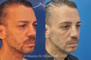 Photo of a patient before and after a procedure. Botox, Cheek Filler, and Upper Blepharoplasty - 55-year-old gentleman treated with Botox Cosmetic to smooth forehead wrinkles and smile lines, and Voluma cheek filler to restore mid-face volume. Upper blepharoplasty was also performed to remove sagging upper eyelids, enhancing overall facial rejuvenation.