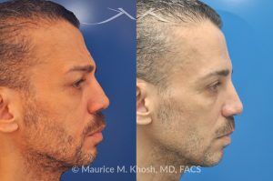 Photo of a patient before and after a procedure. Botox, Cheek Filler, and Upper Blepharoplasty - 55-year-old gentleman treated with Botox Cosmetic to smooth forehead wrinkles and smile lines, and Voluma cheek filler to restore mid-face volume. Upper blepharoplasty was also performed to remove sagging upper eyelids, enhancing overall facial rejuvenation.