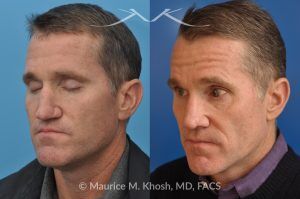 Photo of a patient before and after a procedure. Nasal Valve Repair with Rib Cartilage Graft - pre- and post-operative.