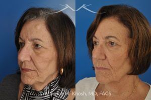 Photo of a patient before and after a procedure. Osteoma Removal from Forehead Under Local Anesthesia - 68 year old lady interested in osteoma removal in Manhattan. Problem: Hard, round, raised mass underneath the forehead skin. Procedure: Osteoma removal as an office procedure, under local anesthesia.