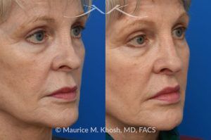 Photo of a patient before and after a procedure. Lip Lift - before and after photo showing enhanced shape and definition of the lips.