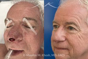 Photo of a patient before and after a procedure. Mohs Excision of Nasal Tip BCC with Local Flap Repair - This lovely patient underwent Mohs excision of basal cell carcinoma of the nasal tip. The defect was repaired with a local flap of nasal skin. The surgery actually helped to improve the nasal appearance by slightly elevating the tip. 