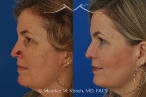 Photo of a patient before and after a procedure. Moh's repair of nose defect after removal of skin cancer. A bilobed flap was used for the repair - before and after photos.