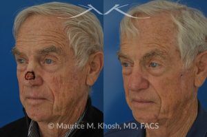 Photo of a patient before and after a procedure. Mohs repair of nose skin cancer with forehead flap - before and after photos.
