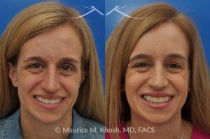 Photo of a patient before and after a procedure. Osteoma of the Left Forehead - before-and-after composite photo.