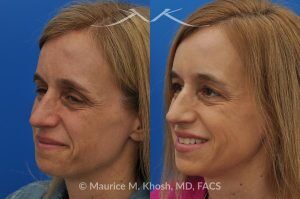 Photo of a patient before and after a procedure. Osteoma of the Left Forehead - before-and-after composite photo.