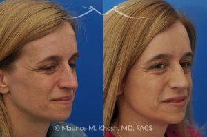 Photo of a patient before and after a procedure. Osteoma of the Left Forehead - before-and-after composite photo.