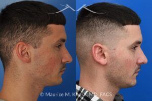Photo of a patient before and after a procedure. Otoplasty to Correct Prominent Ears and Reduce Left Ear Size - This 26 year-old requested consultation regarding earpinnig and reducing the size of the left ear. He found both ears to be sticking out too far, and noted the left ear to be larger than the right side. Otopalsty was performed under local anesthesia in our Manhattan office. Both ears were pushed closer to the scalp. The left ear was shortened.