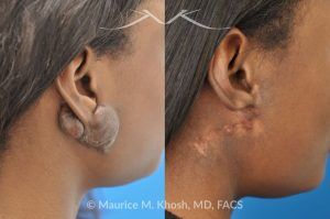Photo of a patient before and after a procedure. Recurrent Earlobe Keloid Treated with Surgery & Radiation - This 24 year old had a keloid of the right which had been excised three times in the past. Each time the keloid recurred and became larger. She was treated with surgical excision followed by radiation therapy. The pictures depict a one year post operative result.
