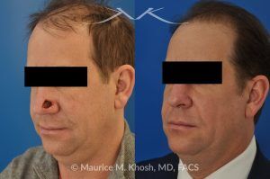 Photo of a patient before and after a procedure. Repair of Moh's defect of the lower nose with local skin flap - before and after photos.