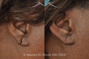 Photo of a patient before and after a procedure. Torn earlobe - repair of torn earlobe.