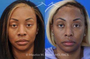 Photo of a patient before and after a procedure. Rhinoplasty to narrow nostrils and bridge of nose, neck liposuction - before and after results.