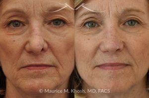 Photo of a patient before and after a procedure. Secondary repair of nostril retraction after attempted Mohs repair of the lower nose - This lovely 60 year-old had undergone repair of Mohs cancer removal from the left lower nose, by another surgeon. Unfortunately, this resulted in severe retraction of the left nostril and an unacceptable nasal deformity. 
Rhinoplasty to address nostril retraction was performed in Manhattan. Cartilage graft to the left nostril and composite graft (combination of skin and cartilage graft) to the inside edge of the nostril, helped to restore normality to the nose. The post op pictures are 6 months following her rhinoplasty.