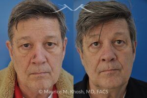 Photo of a patient before and after a procedure. Patient with basal cell skin cancer removed from the right lower nose - The nose defect was repaired with a skin graft obtained from the skin in front of the ear.