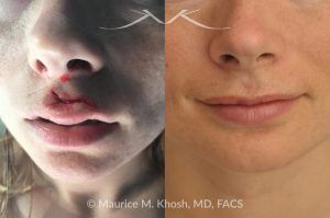 Photo of a patient before and after a procedure. Torn upper lip repair - This 25 year old suffered an upper lip laceration due to a surfing accident. She had repair of the laceration locally in Central America, but had to undergo revision of the repair when she returned to New York. The photograph is three months after the repair.