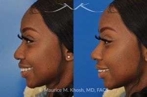 Photo of a patient before and after a procedure. Liquid rhinoplasty - This delightful patient was interested in improving the appearance of her nose without surgery. She disliked the droopy tip which became even more droopy when she smiled. She wanted more definition in the tip. Filler injections allowed us to improve the nasal tip position and shape, while a small injection into the bridge of the nose helped to eliminate the small hump. The patient was ecstatic with the results of her liquid rhinoplasty. 