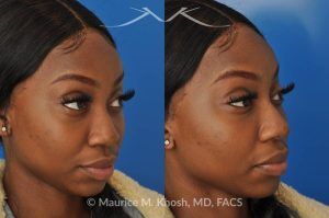Photo of a patient before and after a procedure. Liquid rhinoplasty - This delightful patient was interested in improving the appearance of her nose without surgery. She disliked the droopy tip which became even more droopy when she smiled. She wanted more definition in the tip. Filler injections allowed us to improve the nasal tip position and shape, while a small injection into the bridge of the nose helped to eliminate the small hump. The patient was ecstatic with the results of her liquid rhinoplasty. 