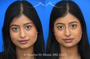 Photo of a patient before and after a procedure. Liquid rhinoplasty - This delightful patient was interested in smoothing a nasal hump and elevating and enhancing her droopy nasal tip. Less than 1 cc of filler was used to achieve these results.
