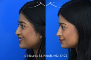 Photo of a patient before and after a procedure. Liquid rhinoplasty - This delightful patient was interested in smoothing a nasal hump and elevating and enhancing her droopy nasal tip. Less than 1 cc of filler was used to achieve these results.