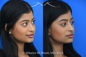 Photo of a patient before and after a procedure. Liquid rhinoplasty - This delightful patient was interested in smoothing a nasal hump and elevating and enhancing her droopy nasal tip. Less than 1 cc of filler was used to achieve these results.