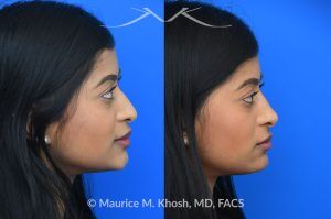 Photo of a patient before and after a procedure. Liquid rhinoplasty - This delightful patient was interested in smoothing a nasal hump and elevating and enhancing her droopy nasal tip. Less than 1 cc of filler was used to achieve these results.