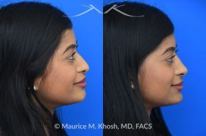 Photo of a patient before and after a procedure. Liquid rhinoplasty - This delightful patient was interested in smoothing a nasal hump and elevating and enhancing her droopy nasal tip. Less than 1 cc of filler was used to achieve these results.