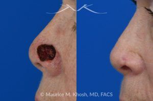 Photo of a patient before and after a procedure. Mohs repair of lower nose - before and after photos.