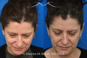 Photo of a patient before and after a procedure. Osteoma - before and after composite photo.