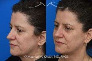 Photo of a patient before and after a procedure. Osteoma - before and after composite photo.