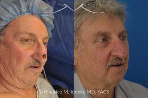Photo of a patient before and after a procedure. Repair of Moh's defect of the lower nose after removal of basal cell cancer of skin. Bilobed flap technique - before and after photos.
