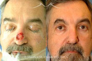 Photo of a patient before and after a procedure. Nose Mohs cancer reconstruction with forehead flap - before and after photos.