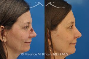 Photo of a patient before and after a procedure. Nose reconstruction - Rhinoplasty for Mohs skin defect of nose after skin cancer removal.