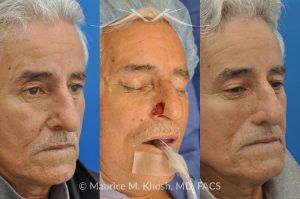Photo of a patient before and after a procedure. Mohs Surgery and Nasal Reconstruction for Basal Cell Carcinoma - This 69 year old gentleman had Basal Cell Carcinoma of the skin of the right nasal lobule (shown on the left side). The skin cancer was removed via the Mohs technique resulting in near total loss of the right nasal ala (central picture). The nose was reconstructed in a two stage operation utilizing a right nasolabial flap and cartilage graft. The final results are shown on the right side of the picture.