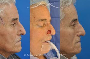 Photo of a patient before and after a procedure. Mohs Surgery and Nasal Reconstruction for Basal Cell Carcinoma - This 69 year old gentleman had Basal Cell Carcinoma of the skin of the right nasal lobule (shown on the left side). The skin cancer was removed via the Mohs technique resulting in near total loss of the right nasal ala (central picture). The nose was reconstructed in a two stage operation utilizing a right nasolabial flap and cartilage graft. The final results are shown on the right side of the picture.
