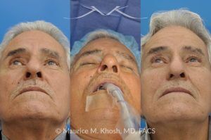 Photo of a patient before and after a procedure. Mohs Surgery and Nasal Reconstruction for Basal Cell Carcinoma - This 69 year old gentleman had Basal Cell Carcinoma of the skin of the right nasal lobule (shown on the left side). The skin cancer was removed via the Mohs technique resulting in near total loss of the right nasal ala (central picture). The nose was reconstructed in a two stage operation utilizing a right nasolabial flap and cartilage graft. The final results are shown on the right side of the picture.