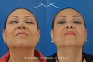 Photo of a patient before and after a procedure. Removal of skin cancer in the tip of the nose with repair - before and after photos.